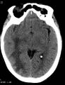 Cerebral metastasis - lung cancer (Radiopaedia 5315-7072 Axial non-contrast 1).jpg
