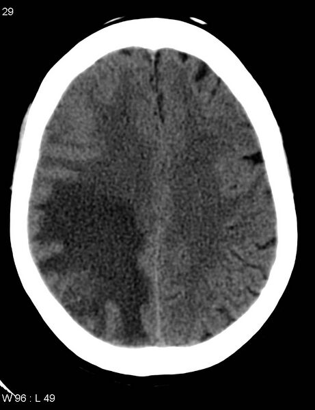File:Cerebral metastasis - lung cancer (Radiopaedia 5315-7072 Axial non-contrast 8).jpg