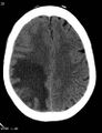 Cerebral metastasis - lung cancer (Radiopaedia 5315-7072 Axial non-contrast 8).jpg