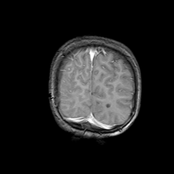File:Cerebral tuberculoma (Radiopaedia 41152-43932 Coronal T1 C+ 20).jpg