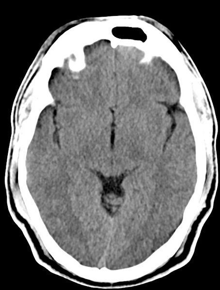 File:Cerebral venous angioma (Radiopaedia 69959-79977 Axial non-contrast 15).jpg