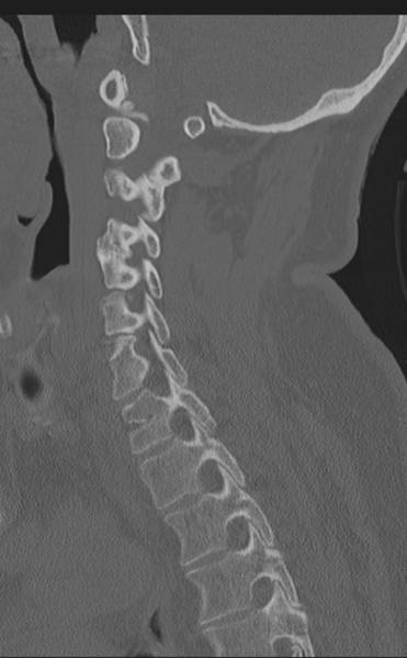 File:Cervical canal stenosis - OPLL and osteophytes (Radiopaedia 47329-51910 Sagittal bone window 30).png
