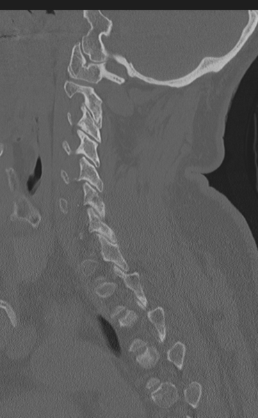 File:Cervical canal stenosis due to ossification of the posterior longitudinal ligament (Radiopaedia 47260-51823 Sagittal bone window 25).png