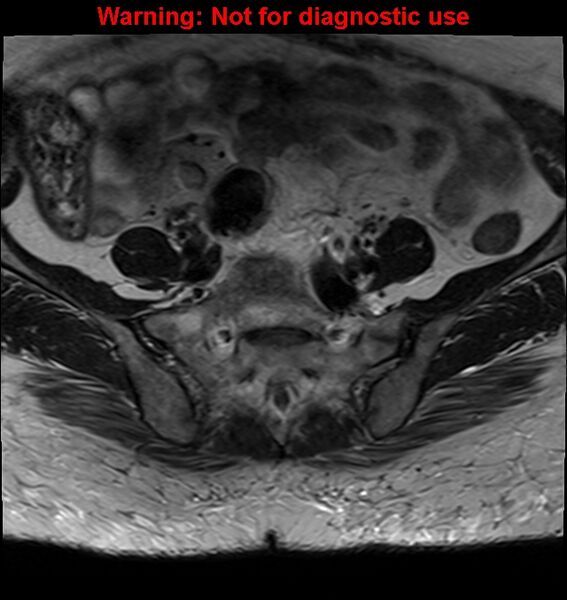 File:Cervical cancer (Radiopaedia 24151-24410 Axial T2 4).jpg