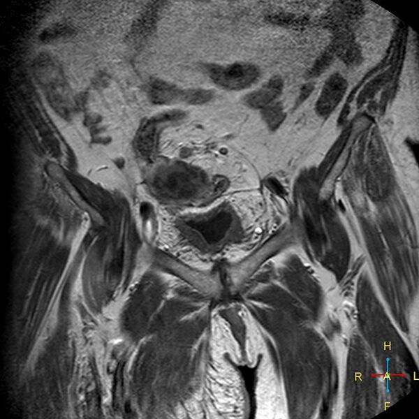 File:Cervical stump squamous cell carcinoma (Radiopaedia 48049-52858 Coronal T1 C+ 1).jpg