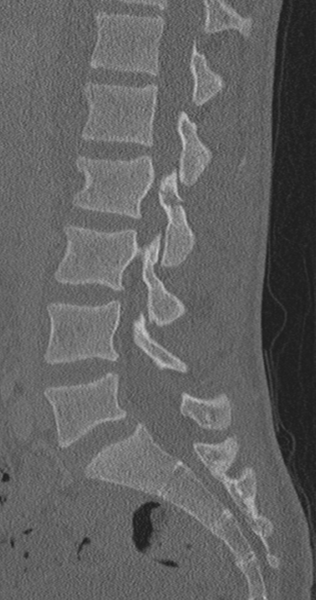 File:Chance fracture (Radiopaedia 40360-42912 Sagittal bone window 56).png