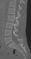 Chance fracture (Radiopaedia 40360-42912 Sagittal bone window 56).png