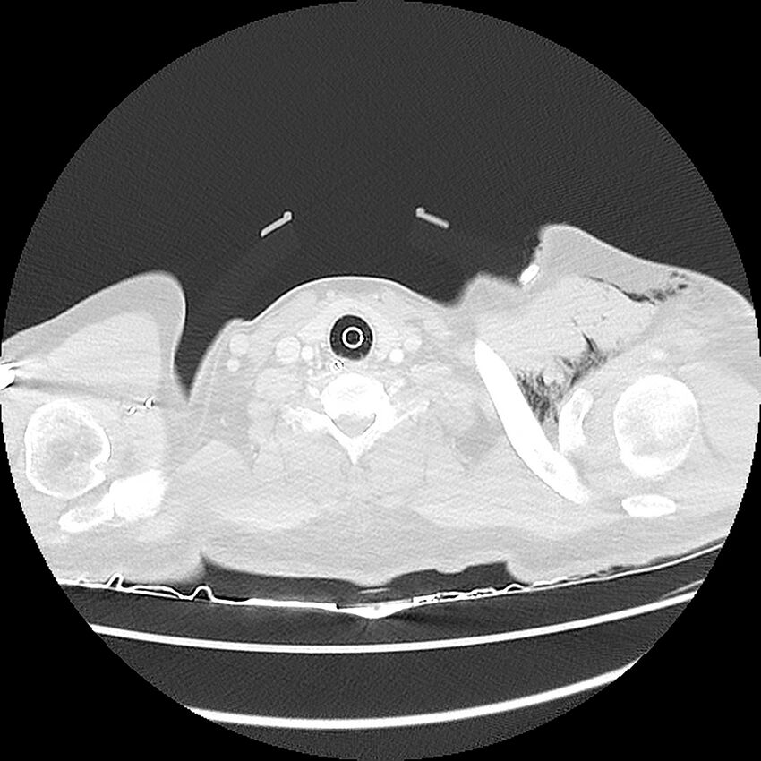 Chest crush injury (Radiopaedia 31620-32513 Axial lung window 2).jpg