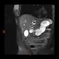 Cholelithiasis with biliary dilatation (Radiopaedia 49442-54589 Coronal T2 14).jpg