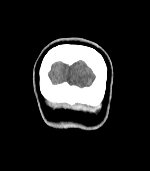 File:Choroid plexus carcinoma (Radiopaedia 91013-108552 Coronal non-contrast 84).jpg