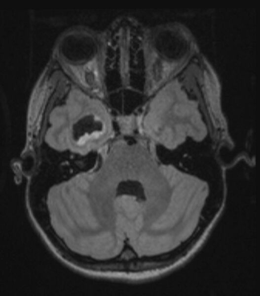 File:Choroid plexus carcinoma (Radiopaedia 91013-108553 Axial FLAIR C+ 99).jpg