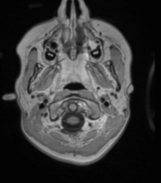 File:Choroid plexus carcinoma (Radiopaedia 91013-108553 Axial T1 C+ 63).jpg