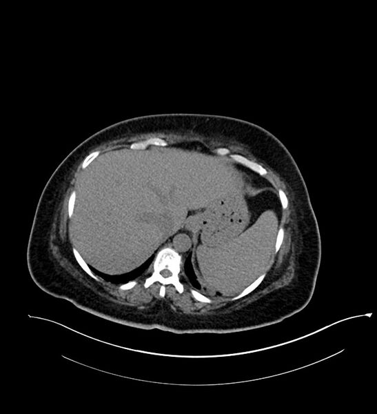 File:Chromophobe renal cell carcinoma (Radiopaedia 84239-99519 Axial non-contrast 35).jpg
