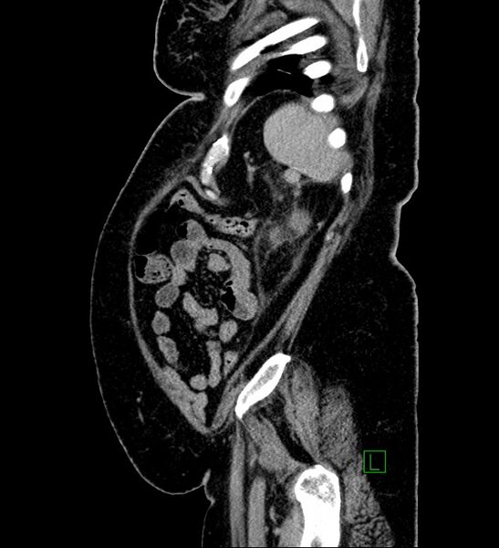 File:Chromophobe renal cell carcinoma (Radiopaedia 84239-99519 G 22).jpg
