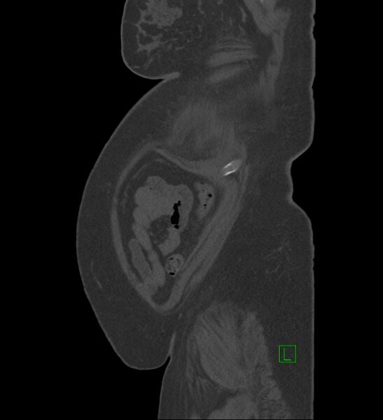 File:Chromophobe renal cell carcinoma (Radiopaedia 84239-99519 Sagittal bone window 7).jpg