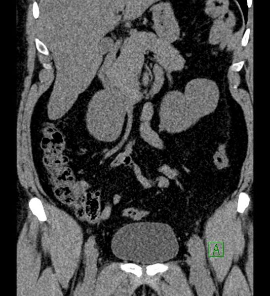 File:Chromophobe renal cell carcinoma (Radiopaedia 84286-99573 Coronal non-contrast 74).jpg