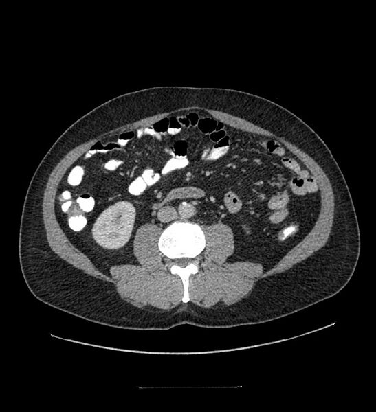 File:Chromophobe renal cell carcinoma (Radiopaedia 84337-99644 C 71).jpg