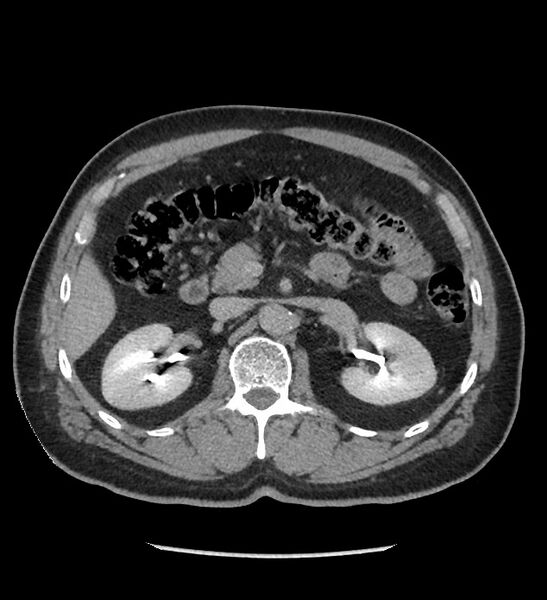 File:Chromophobe renal cell carcinoma (Radiopaedia 86879-103083 D 53).jpg