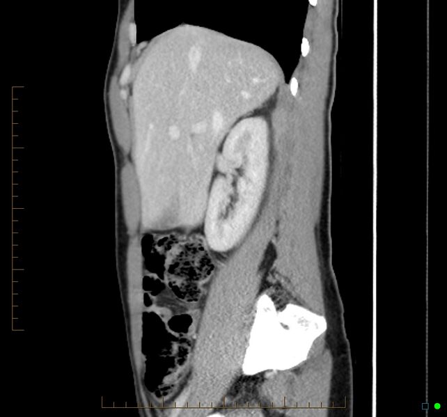 File:Chronic abscess due to "dropped" appendicoliths following appendectomy for perforated appendix (Radiopaedia 58805-66344 D 39).jpg