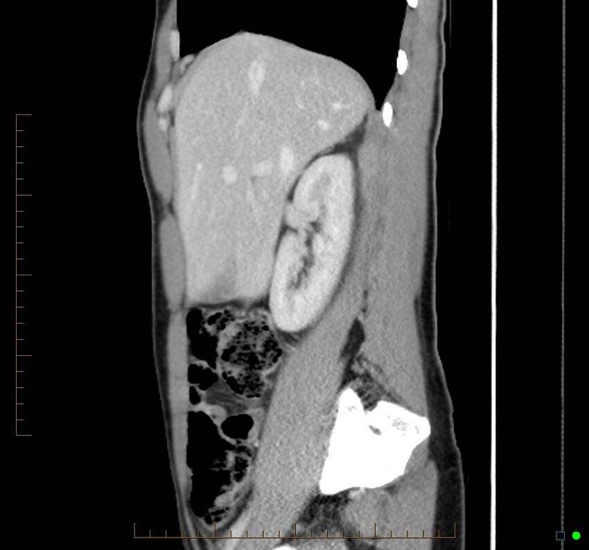 Chronic abscess due to "dropped" appendicoliths following appendectomy for perforated appendix (Radiopaedia 58805-66344 D 39).jpg