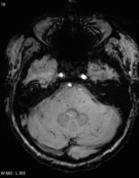 File:Chronic lymphocytic inflammation with pontine perivascular enhancement responsive to steroids (CLIPPERS) (Radiopaedia 37520-39374 Axial SWI 18).jpg