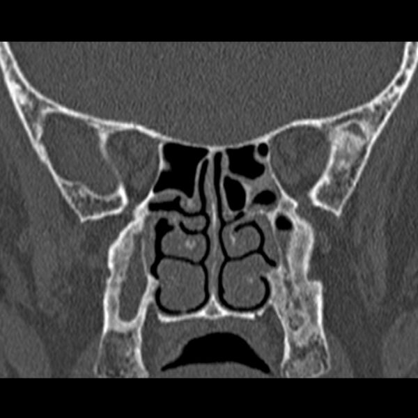 File:Chronic maxillary sinusitis (Radiopaedia 27879-28116 Coronal bone window 34).jpg
