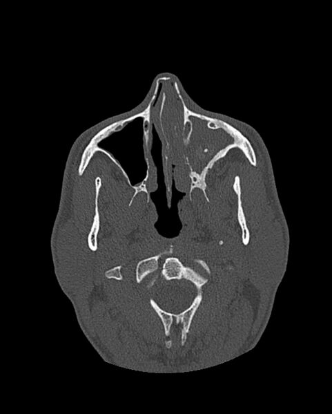 File:Chronic maxillary sinusitis caused by a foreign body (Radiopaedia 58521-65676 Axial bone window 117).jpg