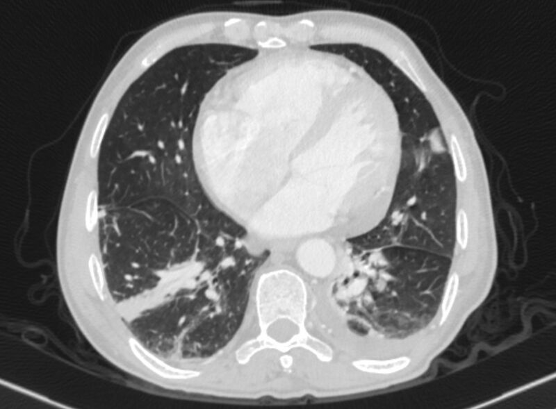 File:Chronic pulmonary embolism with bubbly consolidation (Radiopaedia 91248-108850 Axial lung window 109).jpg