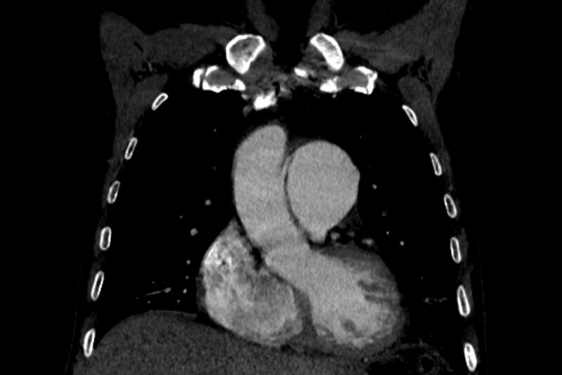 File:Chronic pulmonary embolism with bubbly consolidation (Radiopaedia 91248-108850 B 45).jpg