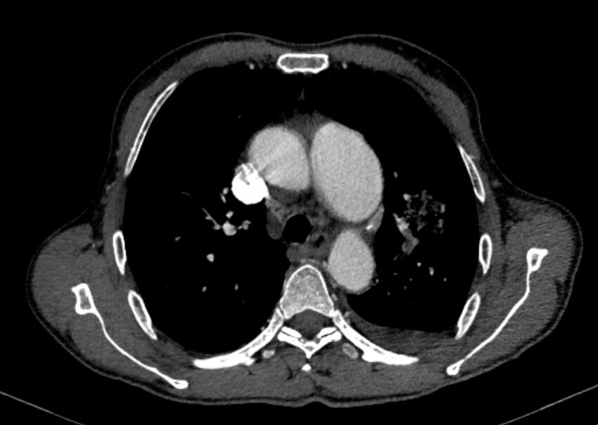 Chronic pulmonary embolism with bubbly consolidation (Radiopaedia 91248-108850 C+ arterial phase 47).jpg
