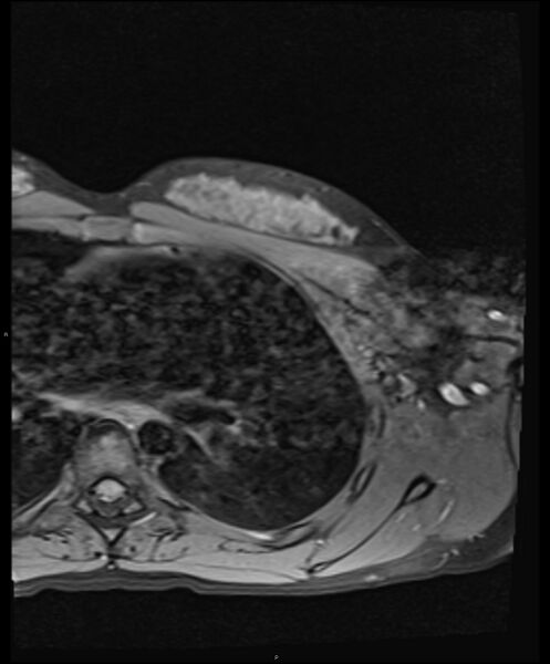 File:Chronic reactive multifocal osteomyelitis (CRMO) - clavicle (Radiopaedia 56406-63114 Axial T1 fat sat 23).jpg