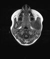 Chronic reactive multifocal osteomyelitis (CRMO) - mandible (Radiopaedia 56405-63069 Axial T1 15).jpg