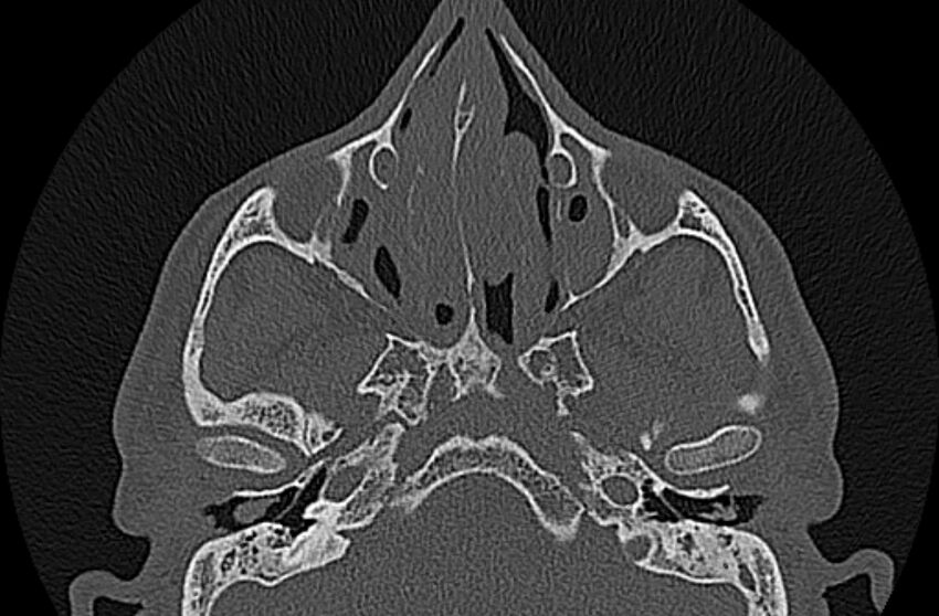 Chronic rhinosinusitis (Radiopaedia 65079-74075 Axial bone window 34).jpg