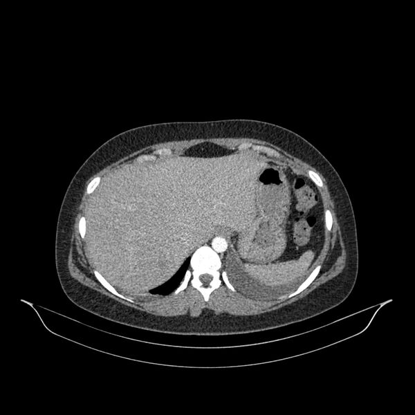 File:Chronic thromboembolic pulmonary hypertension (CTEPH) (Radiopaedia 74597-85532 Axial C+ CTPA 17).jpg