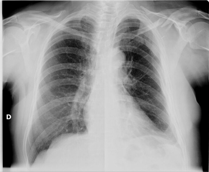 File:Clavicle and rib fractures (Radiopaedia 46123-50528 Frontal 1).jpg
