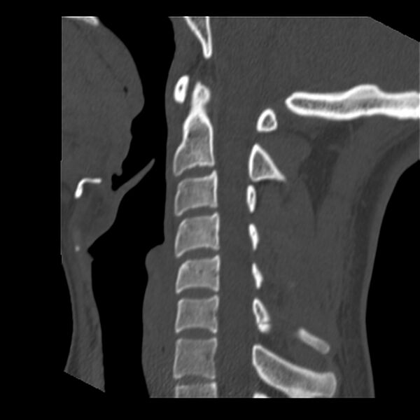 File:Clay-shoveler fracture (Radiopaedia 22568-22590 Sagittal bone window 24).jpg