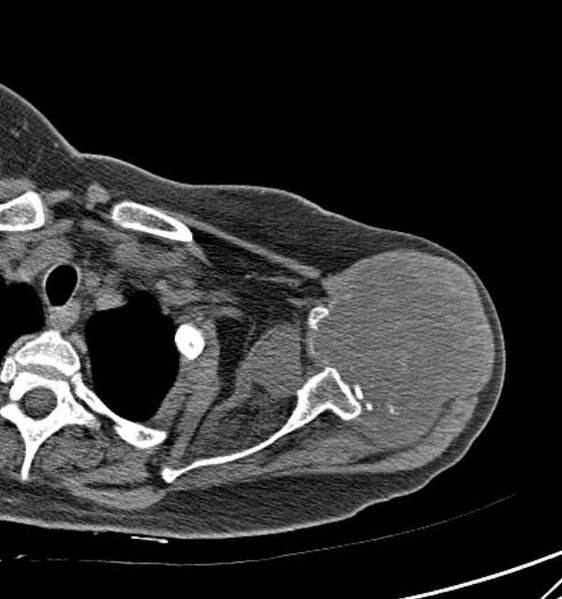File:Clear cell chondrosarcoma - humerus (Radiopaedia 63104-71612 Axial non-contrast 32).jpg