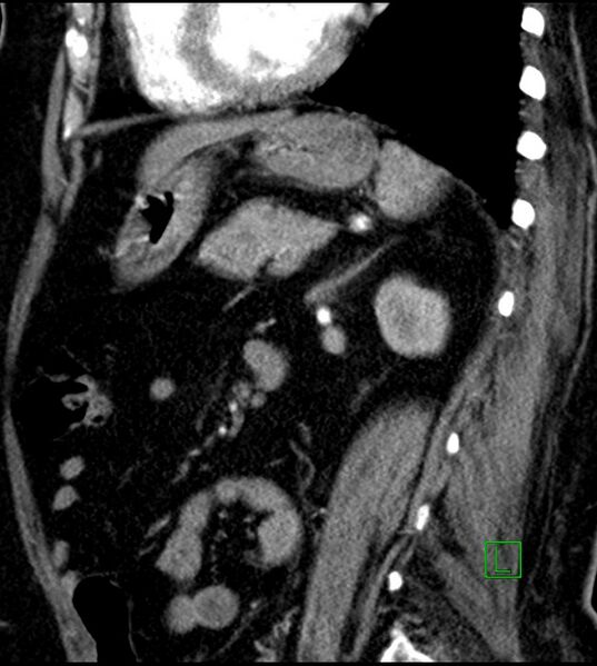 File:Clear cell renal cell carcinoma (Radiopaedia 85004-100537 D 24).jpg