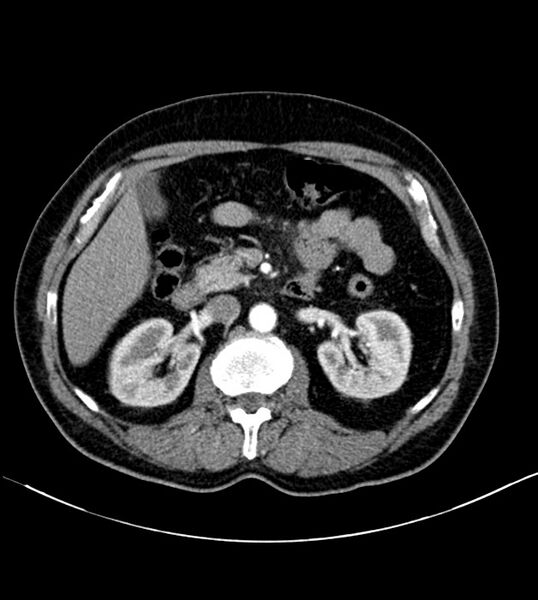 File:Clear cell renal cell carcinoma (Radiopaedia 85006-100539 B 36).jpg