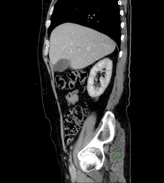 File:Clear cell renal cell carcinoma (Radiopaedia 85006-100539 G 46).jpg