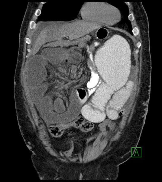 File:Closed-loop small bowel obstruction-internal hernia (Radiopaedia 78439-91096 Coronal non-contrast 32).jpg