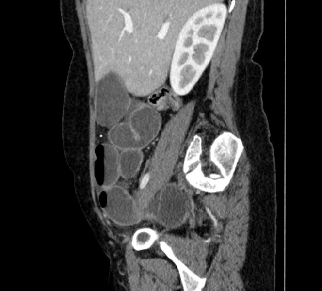 File:Closed loop small bowel obstruction (Radiopaedia 71211-81508 C 31).jpg