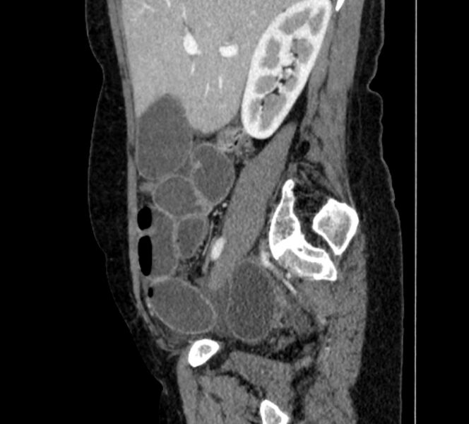 File:Closed loop small bowel obstruction (Radiopaedia 71211-81508 C 35).jpg