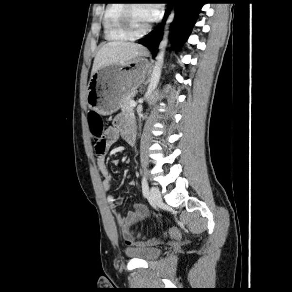 File:Co-existing acute appendicitis and epiploic appendagitis (Radiopaedia 61789-69911 B 56).jpg
