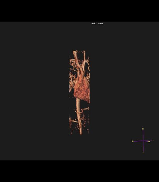 File:Coarctation of the aorta (Radiopaedia 43373-46729 3D reconstruction 27).jpg