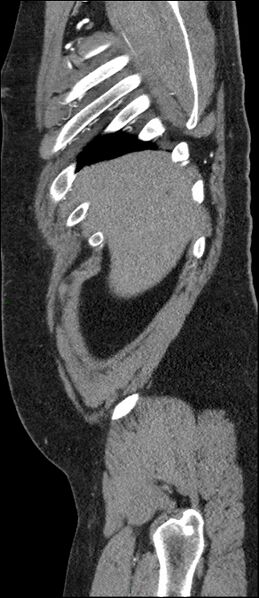 File:Coarctation of the aorta (Radiopaedia 74632-88521 C 26).jpg