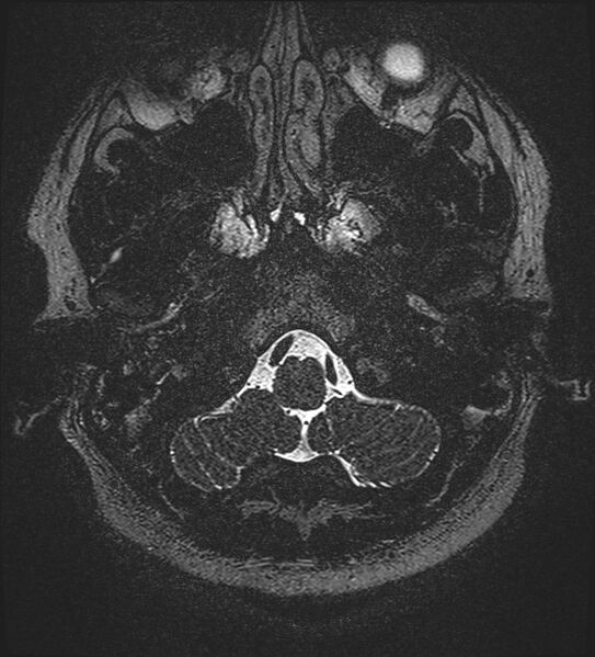 File:Cochlear incomplete partition type III associated with hypothalamic hamartoma (Radiopaedia 88756-105498 Axial T2 20).jpg