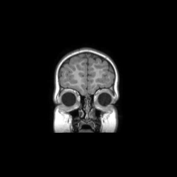 File:Cochlear nerve aplasia - unilateral (Radiopaedia 87910-104413 Coronal T1 7).jpg