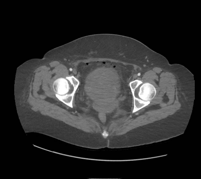File:Colonic pseudo-obstruction (Radiopaedia 79752-92980 A 177).png
