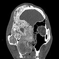 Craniofacial fibrous dysplasia (Radiopaedia 9631).jpg